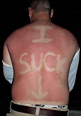 sunburn1